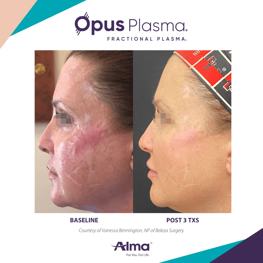 Opus Plasma skin resurfacing before and after results at Mantra Health and Wellness in Modesto, CA