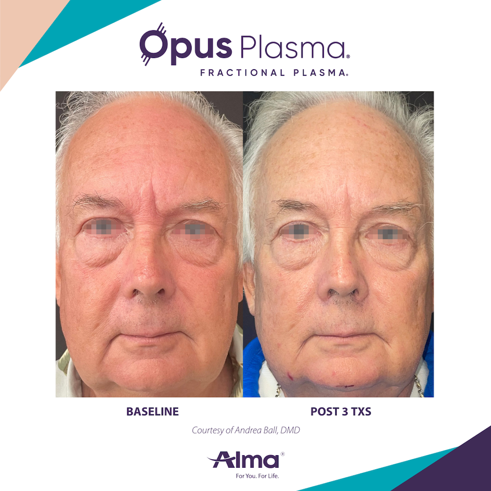 Opus Plasma skin resurfacing before and after results at Mantra Health and Wellness in Modesto, CA