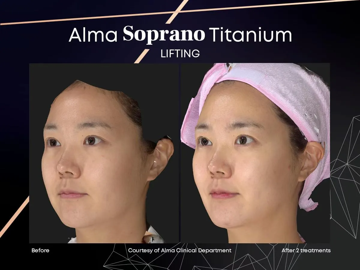 Alma Titanium skin tightening before and after results at Mantra Health and Wellness in Modesto, CA