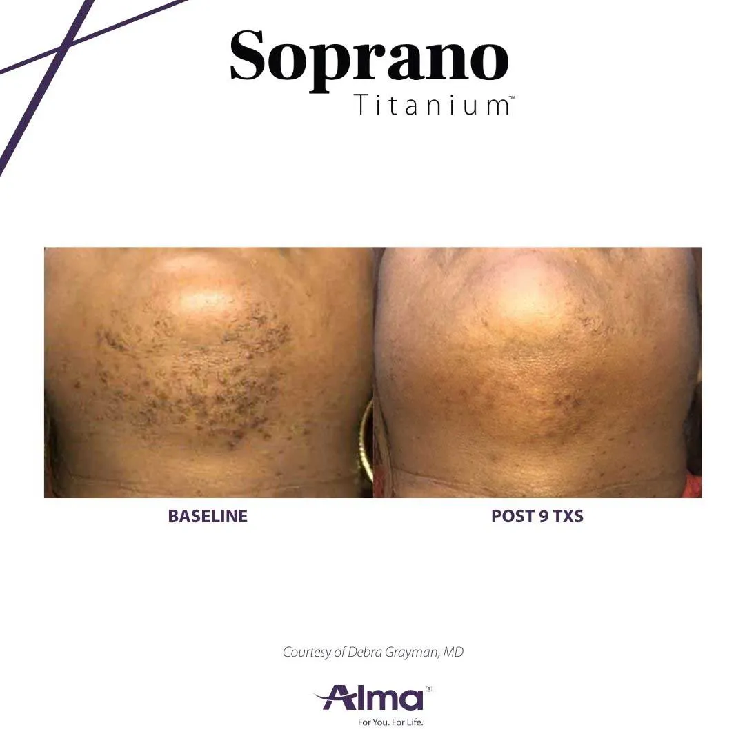 Alma Titanium laser hair removal before and after results at Mantra Health and Wellness in Modesto, CA