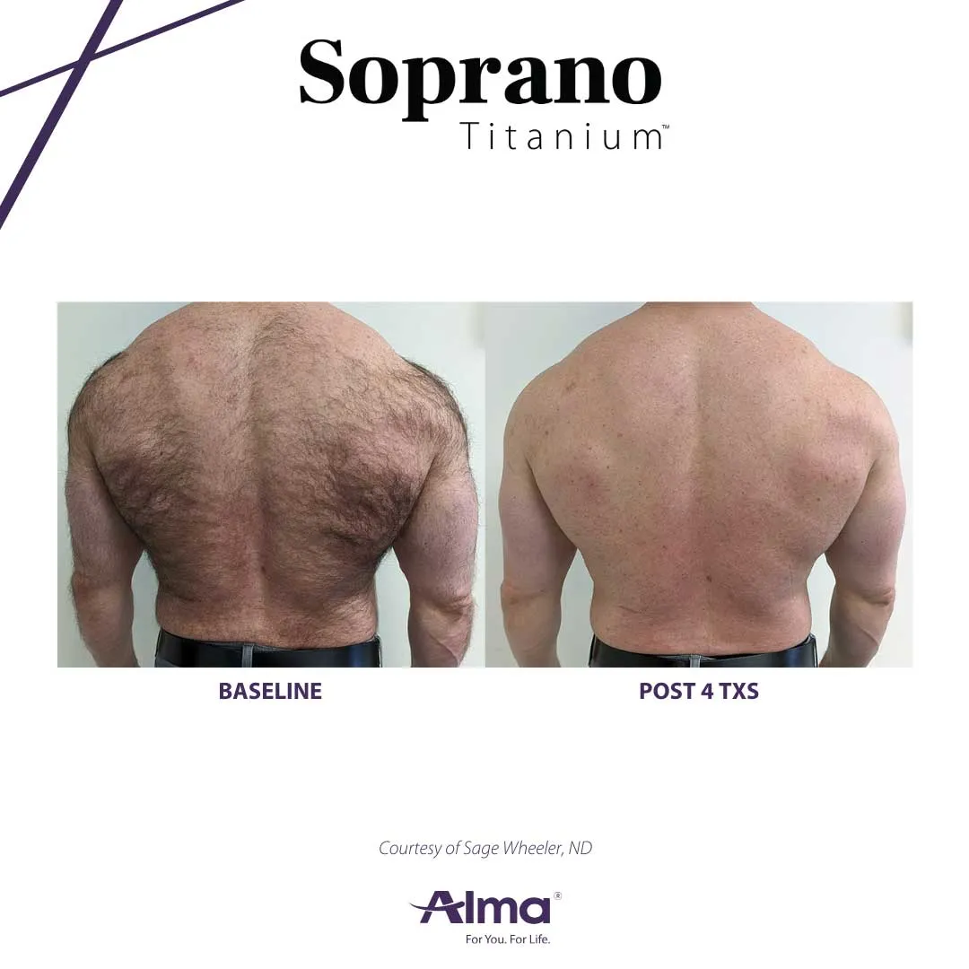 Alma Titanium laser hair removal before and after results at Mantra Health and Wellness in Modesto, CA