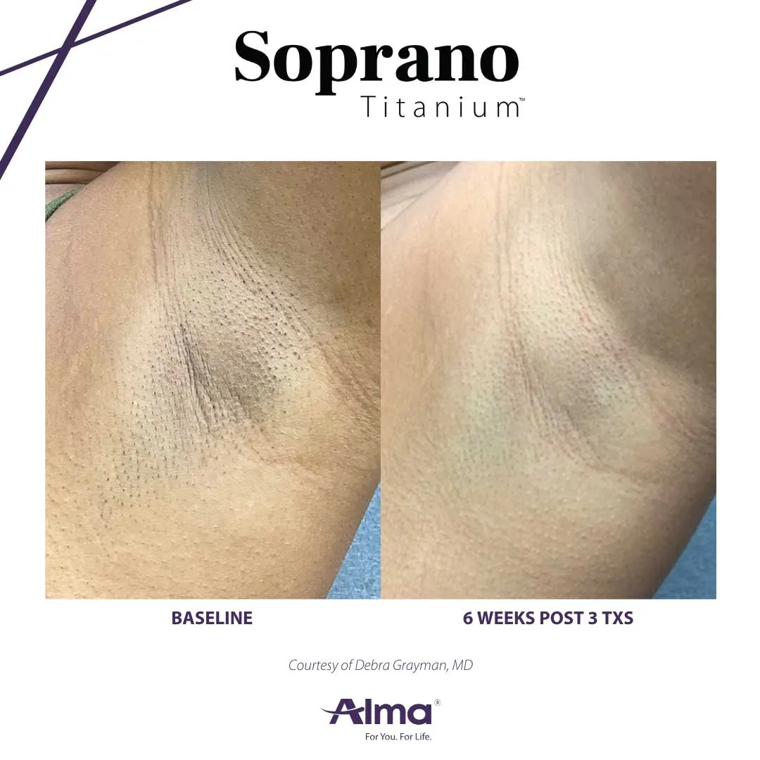 Alma Titanium laser hair removal before and after results at Mantra Health and Wellness in Modesto, CA