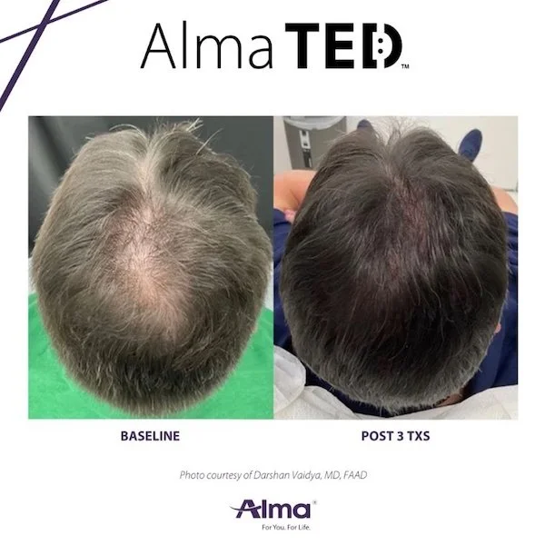Alma TED hair restoration before and after results at Mantra Health and Wellness in Modesto, CA