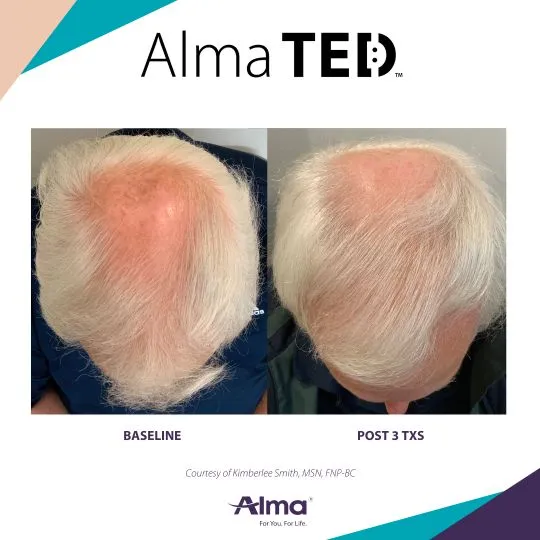 Alma TED hair restoration before and after results at Mantra Health and Wellness in Modesto, CA