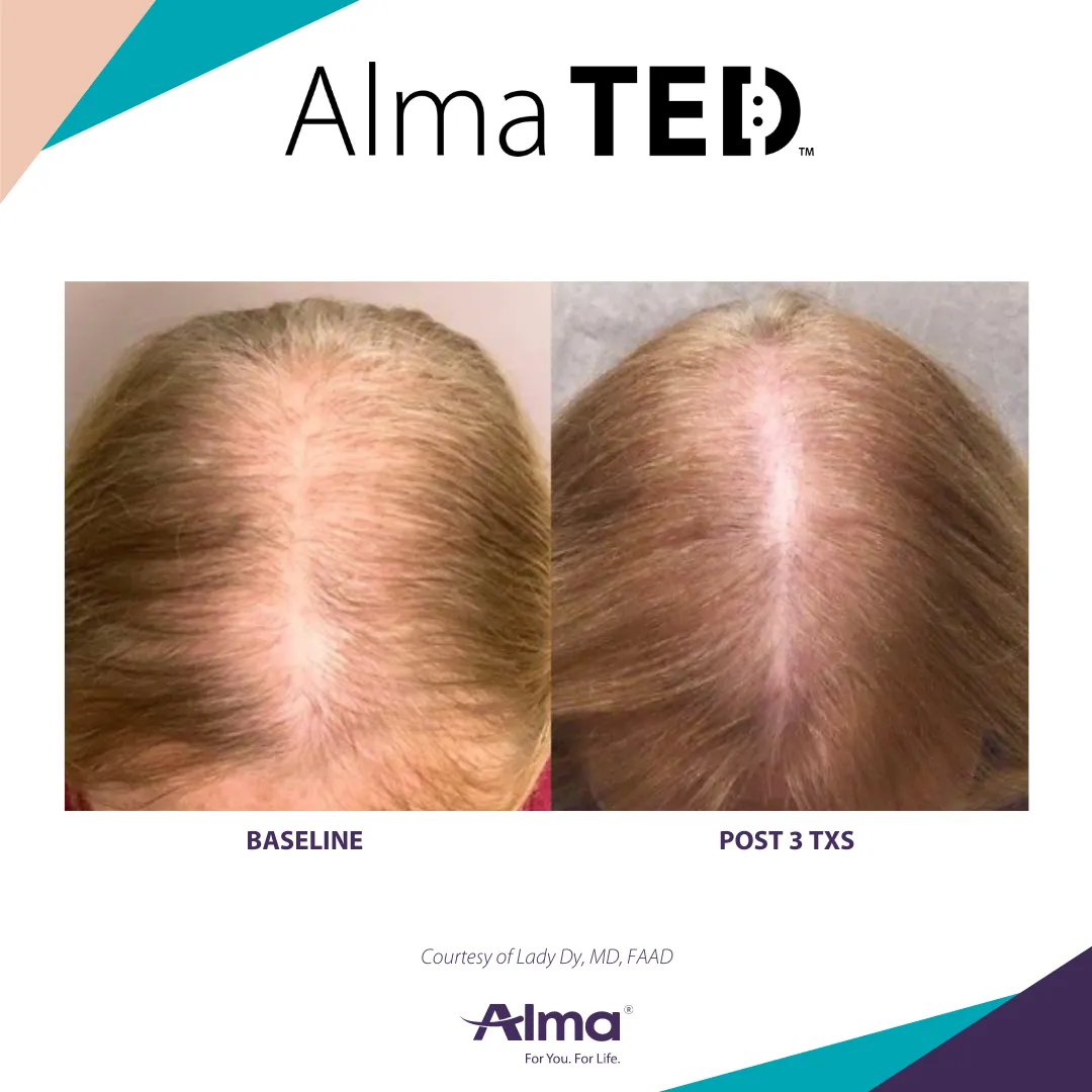 Alma TED hair restoration before and after results at Mantra Health and Wellness in Modesto, CA