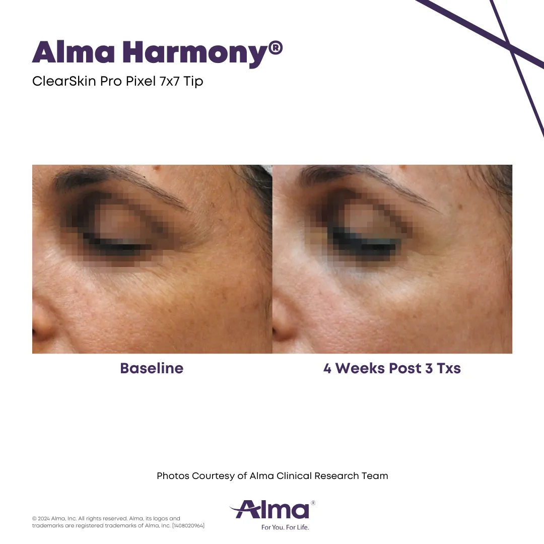 ClearSkin laser skin rejuvenation before and after results at Mantra Health and Wellness in Modesto, CA