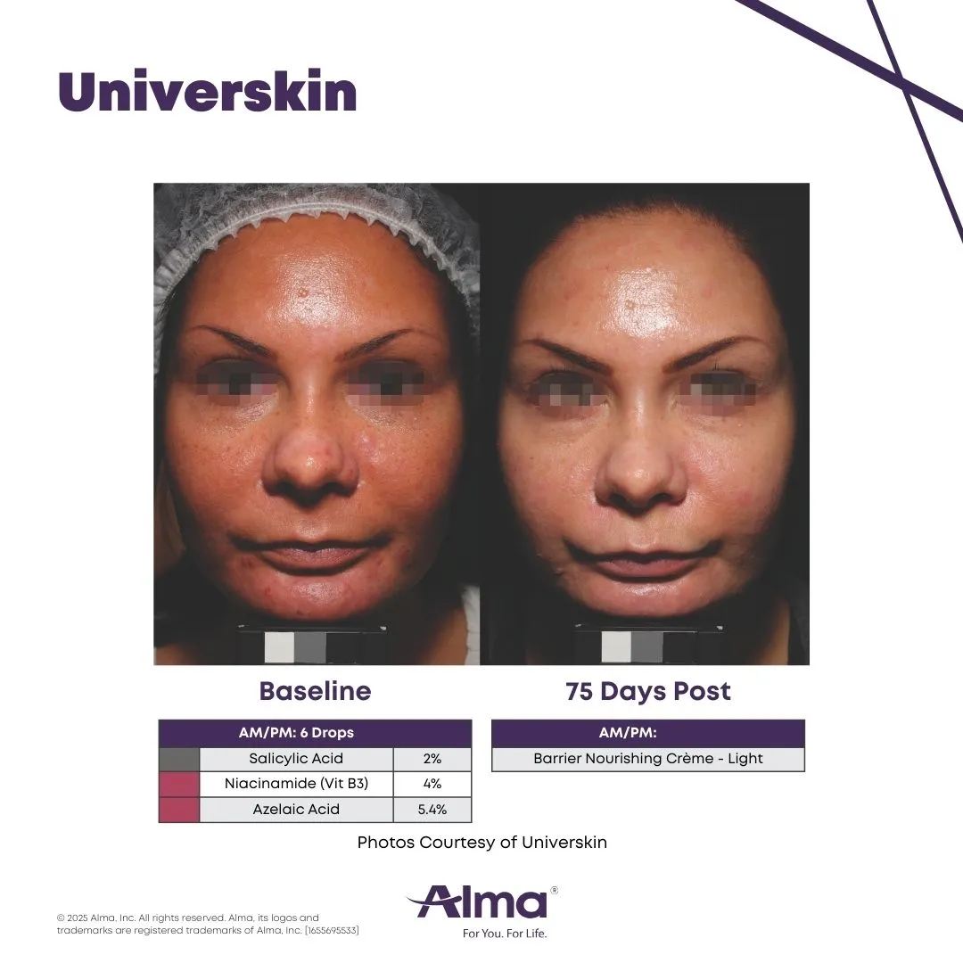 Universkin personalized skincare before and after results at Mantra Health and Wellness in Modesto, CA