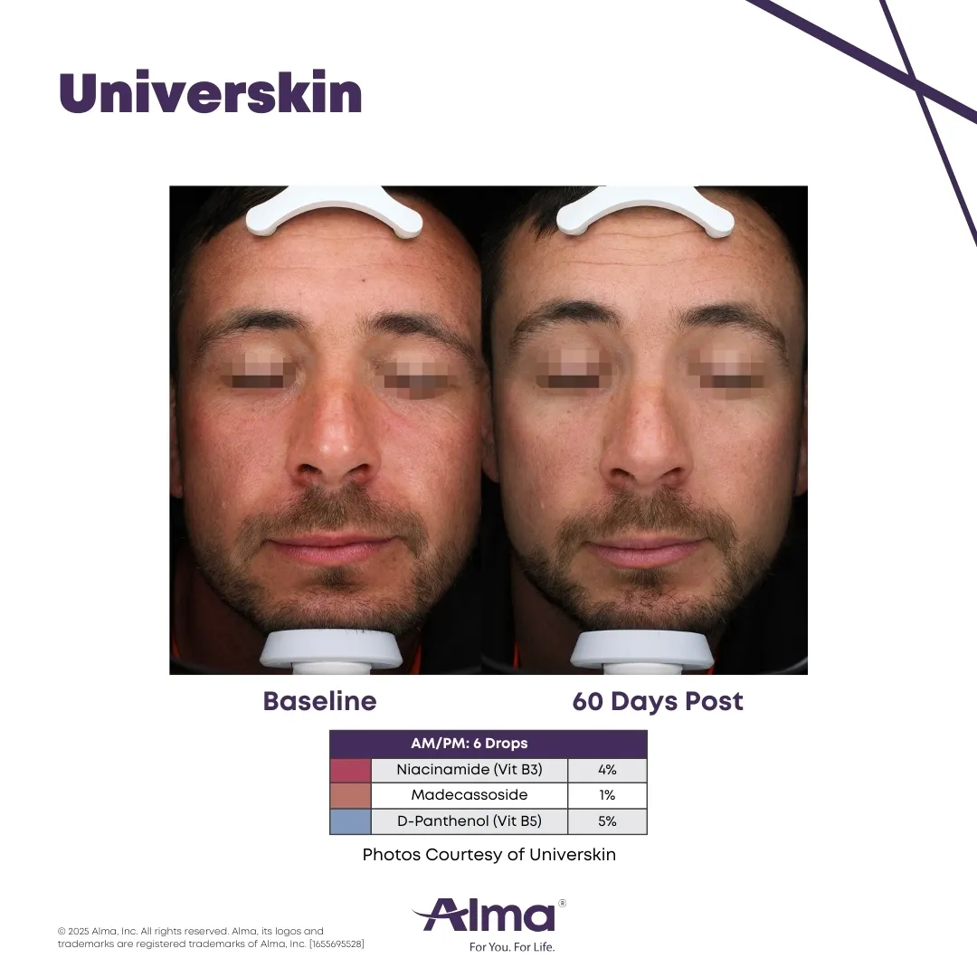 Universkin personalized skincare before and after results at Mantra Health and Wellness in Modesto, CA