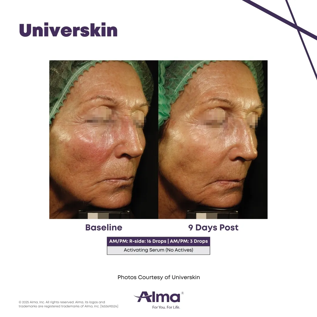 Universkin personalized skincare before and after results at Mantra Health and Wellness in Modesto, CA