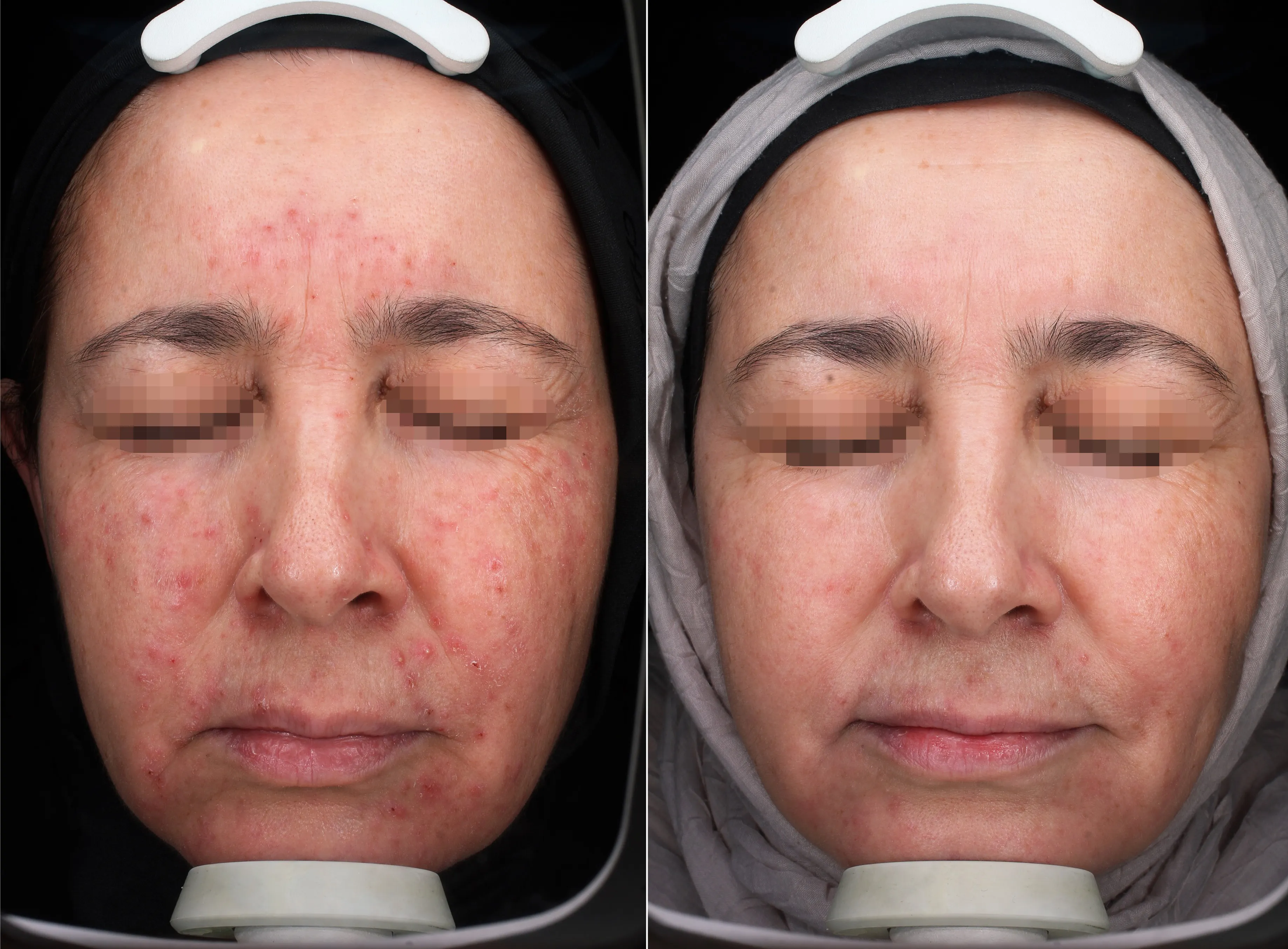 Universkin personalized skincare before and after results at Mantra Health and Wellness in Modesto, CA
