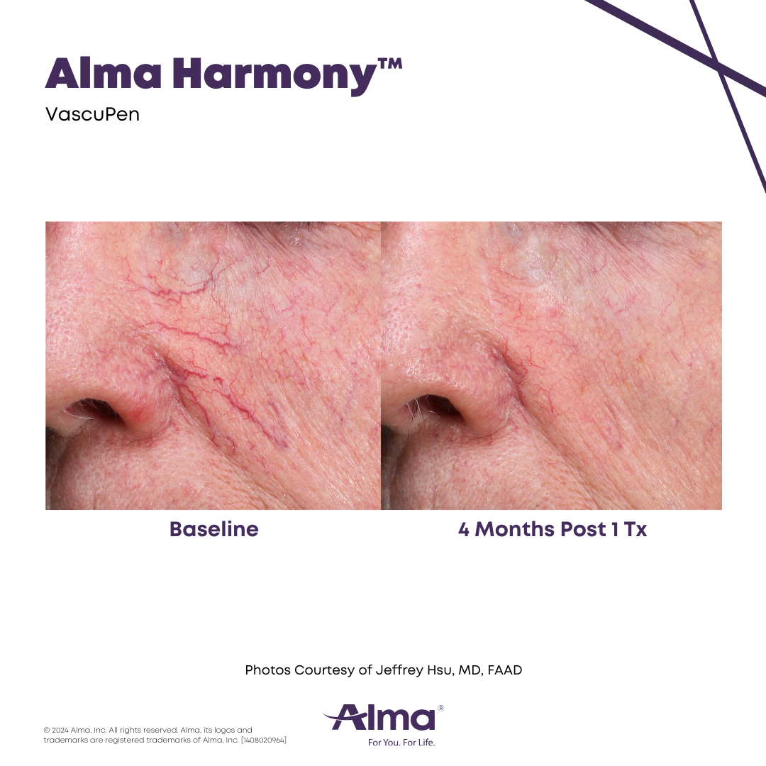 Vascupen vascular lesion treatment before and after results at Mantra Health and Wellness in Modesto, CA