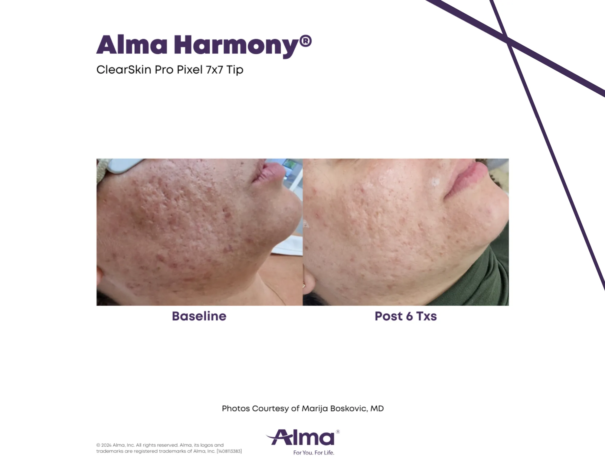 ClearSkin laser skin rejuvenation before and after results at Mantra Health and Wellness in Modesto, CA