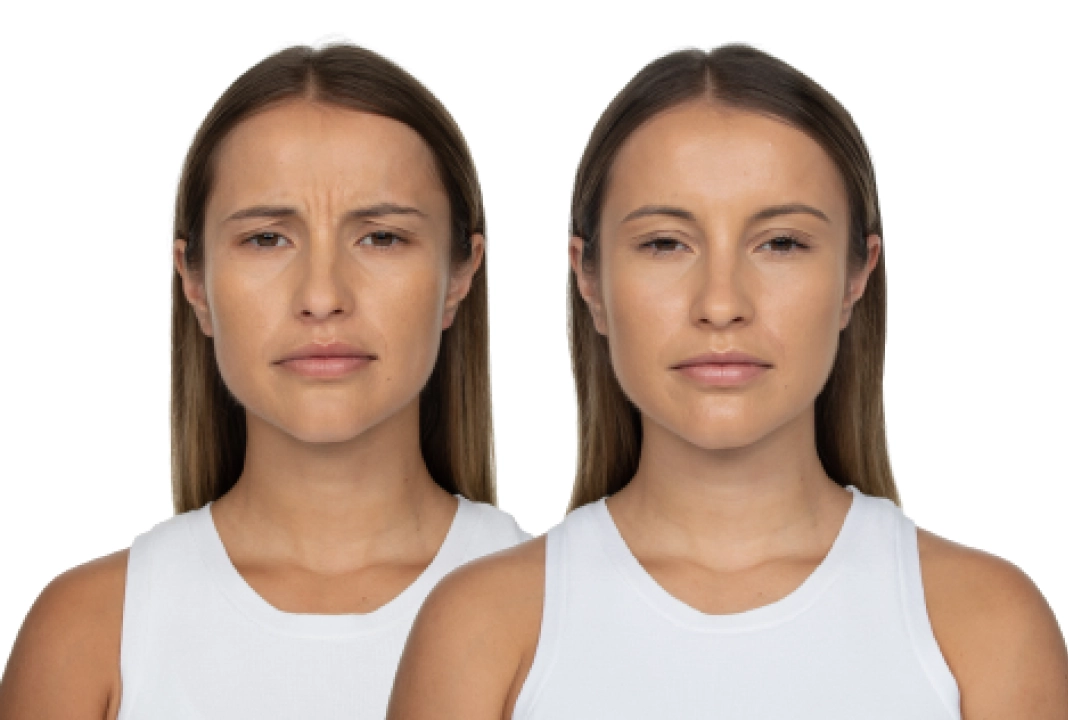 Neurotoxin wrinkle treatment before and after results at Mantra Health and Wellness in Modesto, CA