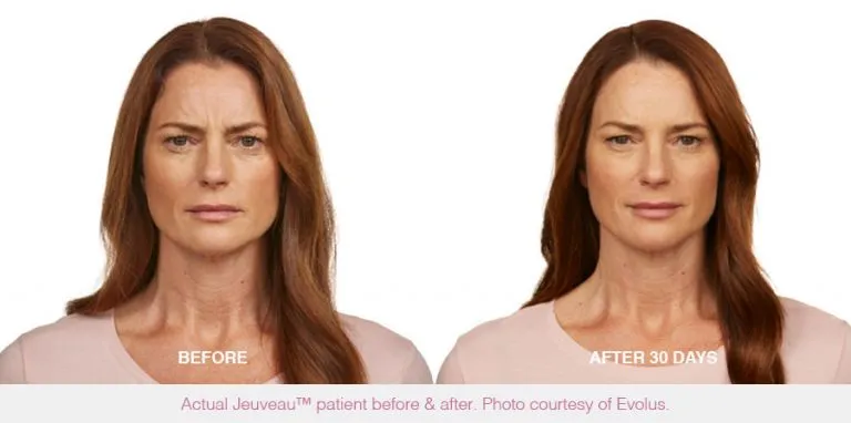 Neurotoxin wrinkle treatment before and after results at Mantra Health and Wellness in Modesto, CA