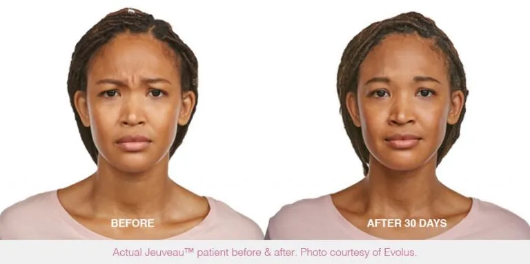 Neurotoxin wrinkle treatment before and after results at Mantra Health and Wellness in Modesto, CA