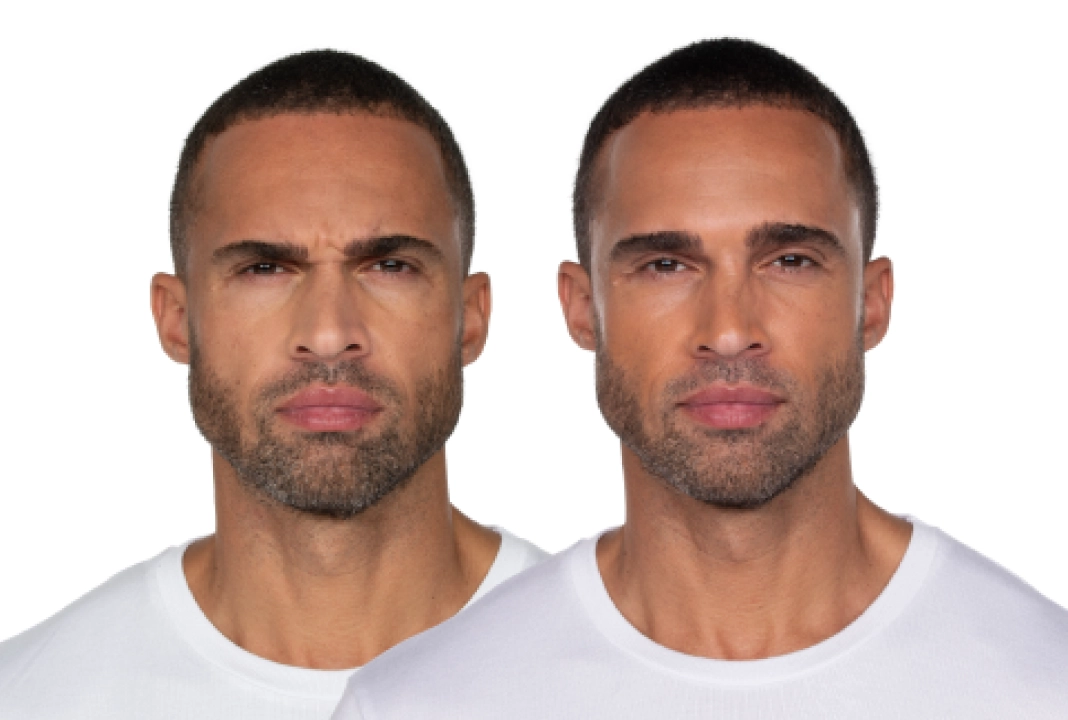 Neurotoxin wrinkle treatment before and after results at Mantra Health and Wellness in Modesto, CA