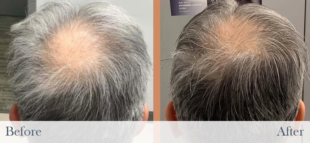 Side-by-side before and after photos showing reduced balding on the crown of a man's gray hair.