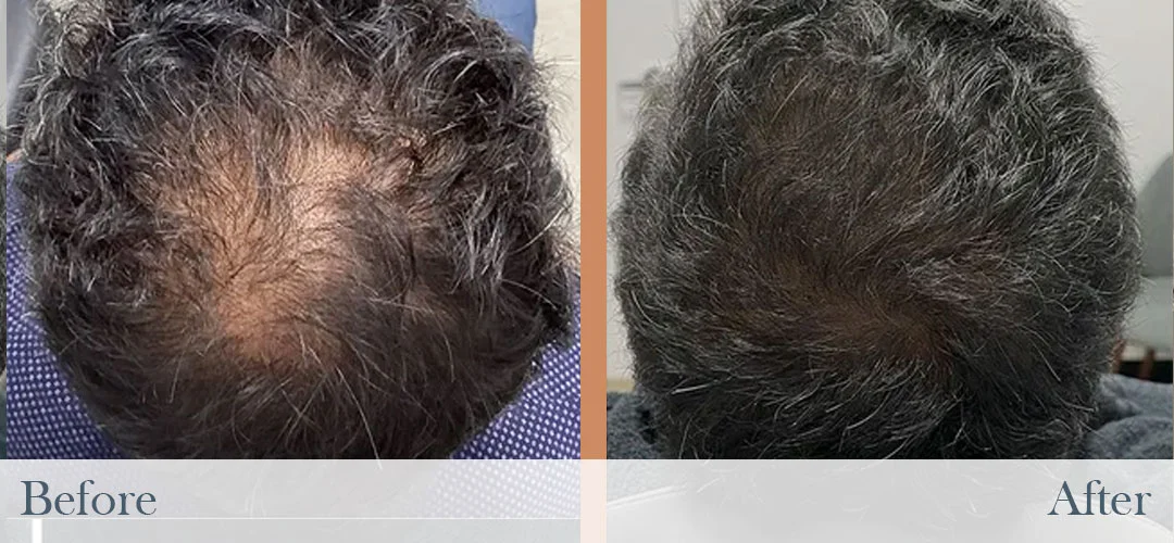 Before and after photos showing noticeable hair regrowth on the top of a man's head.