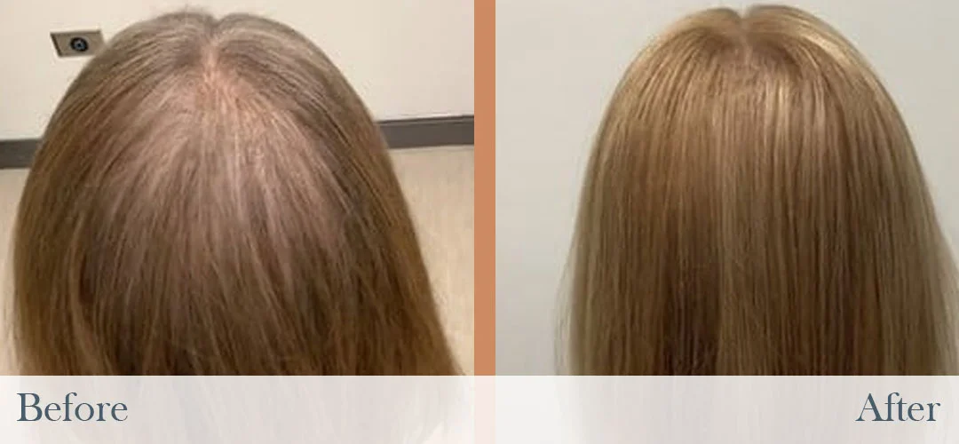 Before and after images showing increased hair density and coverage on a woman's scalp.