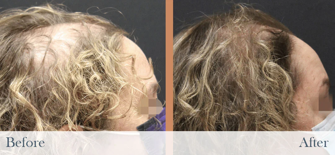Side-by-side before and after images showing hair regrowth on a person's scalp.