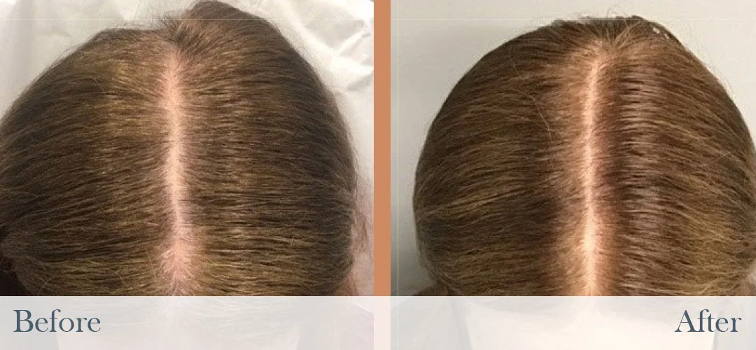Side-by-side before and after photos showing improved hair density on top of a person's head.