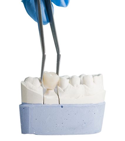O mână cu mănușă albastră ținând o pensetă care plasează o coroană dentară pe un model de gips cu dinți.
