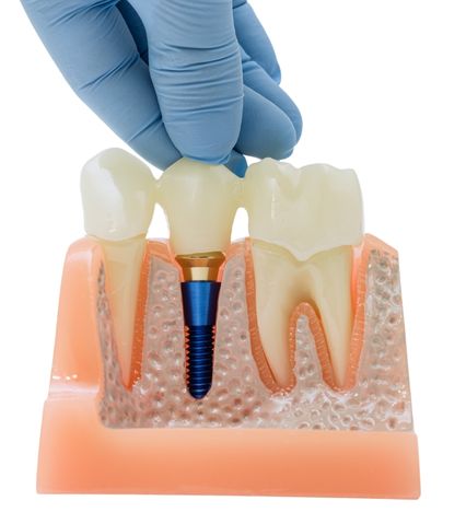 Mână cu mănușă albastră care ține o coroană dentară montată pe un implant artificial într-un model de josul maxilarului.
