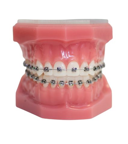 Model of teeth with metal braces on upper and lower teeth.