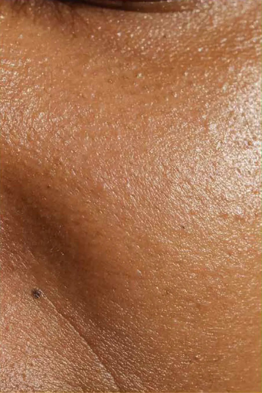 Close-up view of brown skin texture with visible pores and a small mole near the lower left.