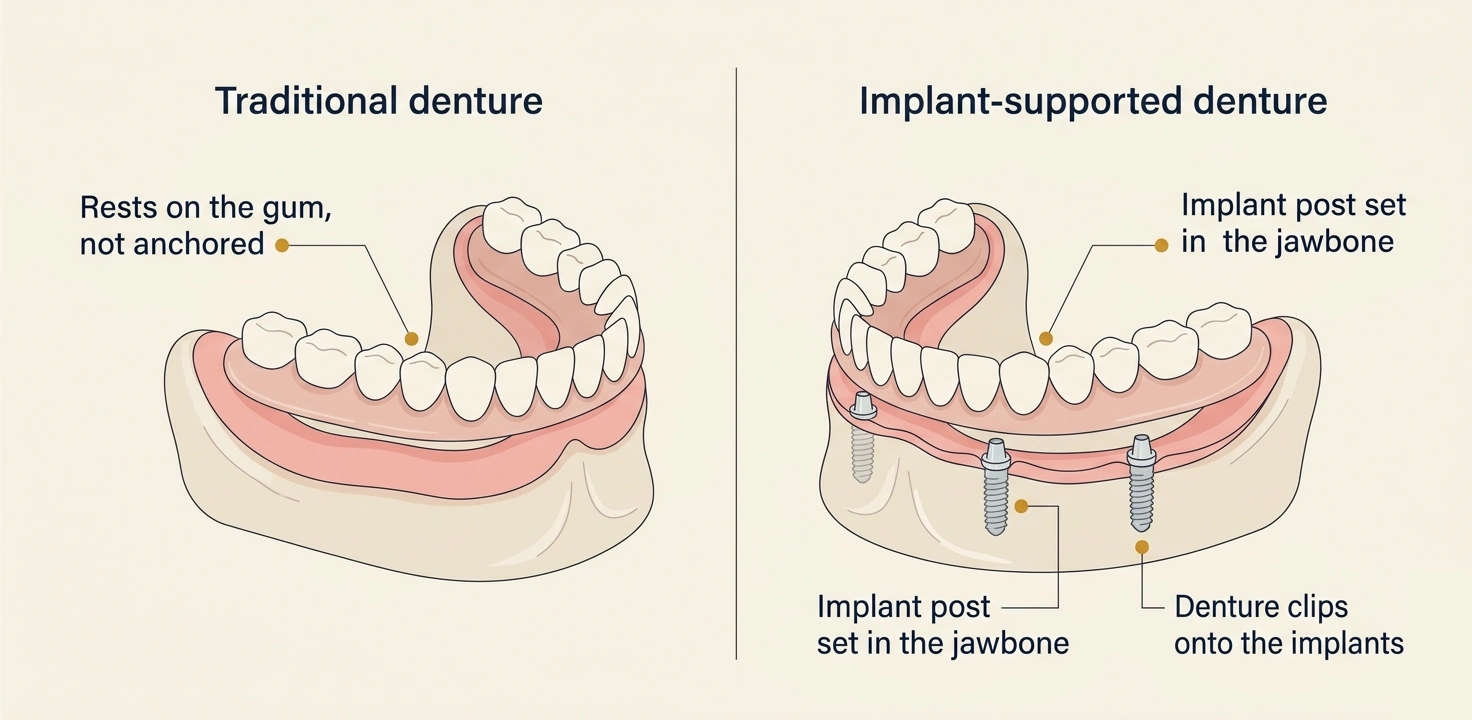 Side-by-side cross-section comparison of a lower jaw. Left: a traditional denture resting on top of the gum with nothing anchoring it. Right: an implant-supported denture clipped onto two titanium implant posts set into the jawbone.
