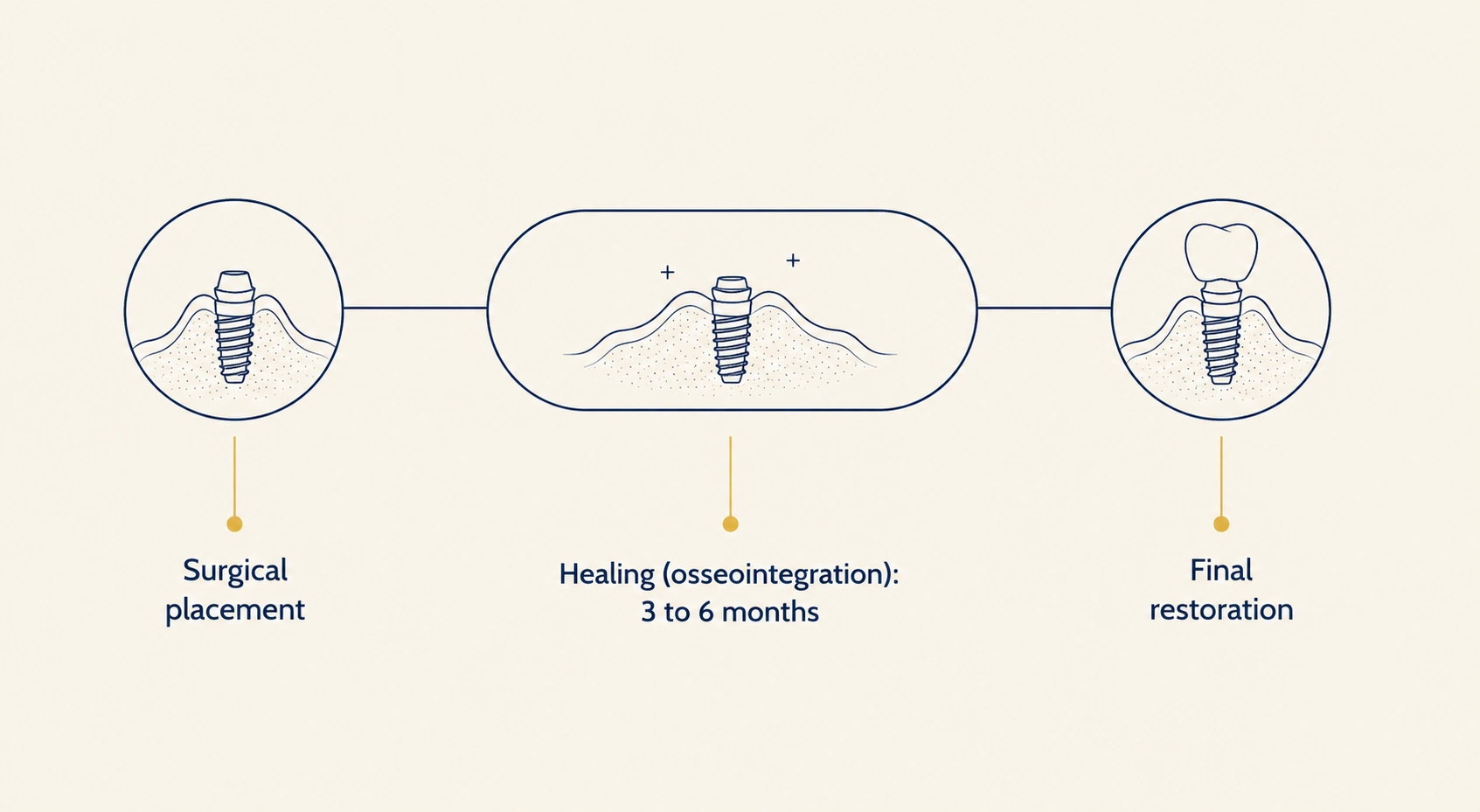 Timeline showing the three stages of a dental implant: surgical placement, three to six months of healing called osseointegration, and the final crown or bridge restoration.