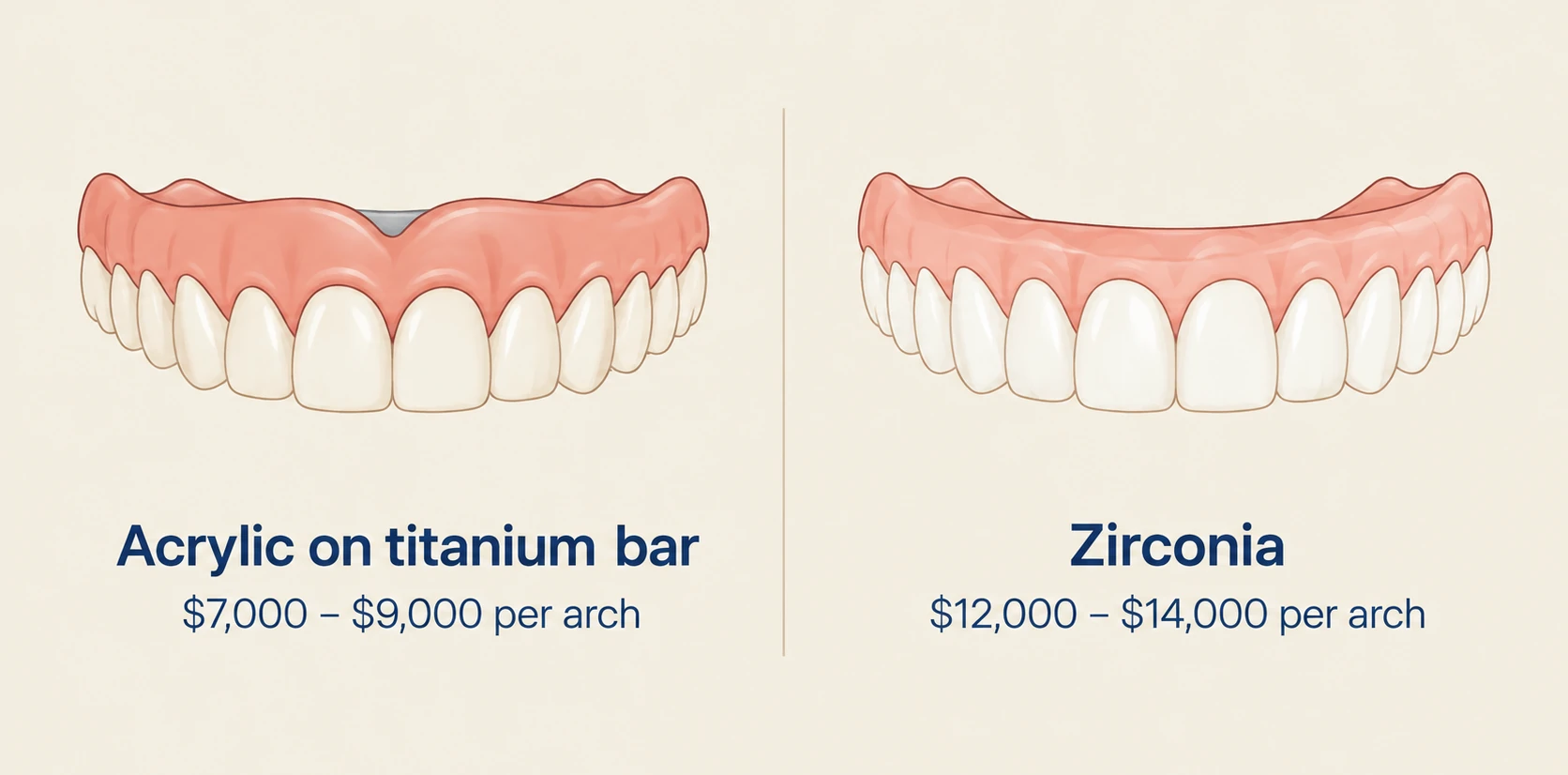 Side-by-side comparison of two full arch dental prostheses. Left: acrylic on titanium bar, $7,000 to $9,000 per arch. Right: zirconia, $12,000 to $14,000 per arch. The zirconia prosthesis has a more refined appearance with less visible gum base.
