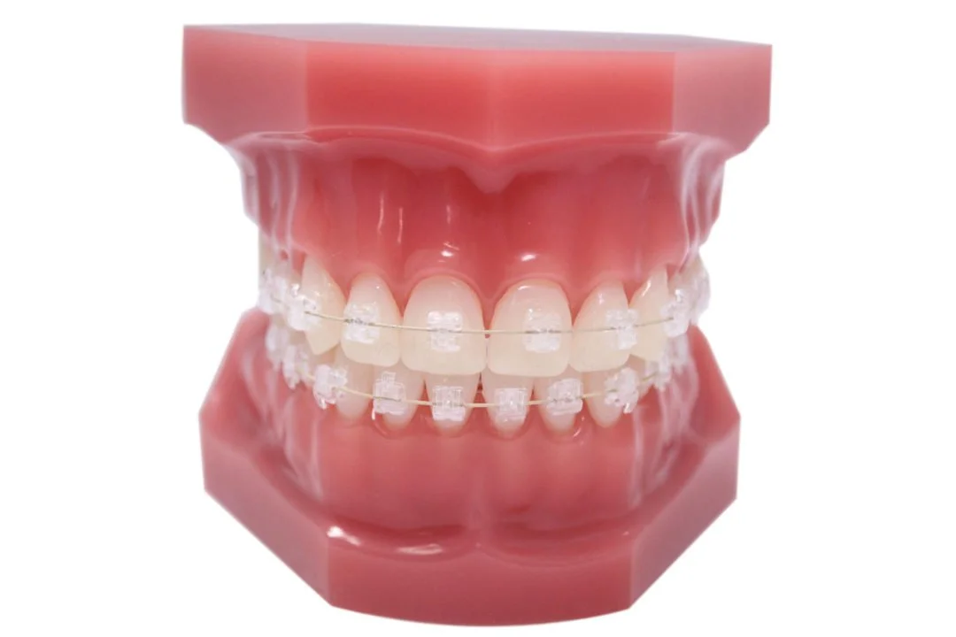 Clear (ceramic) braces
