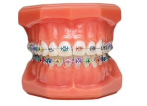 Traditional metal braces