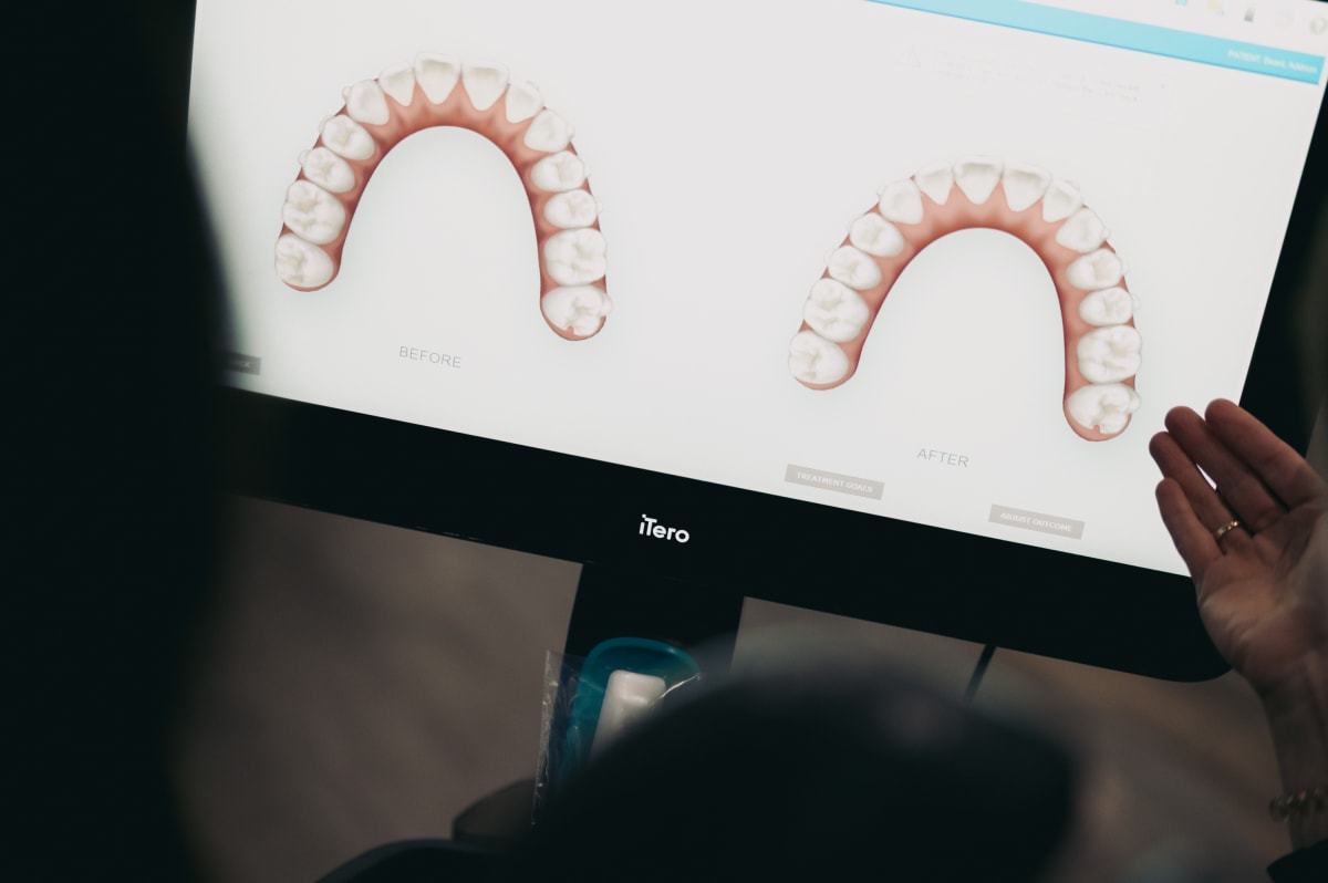 Close-up of dental sealant models displayed on a monitor showing tooth anatomy