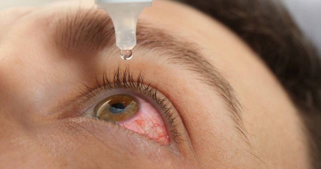 applying eye drops to eye