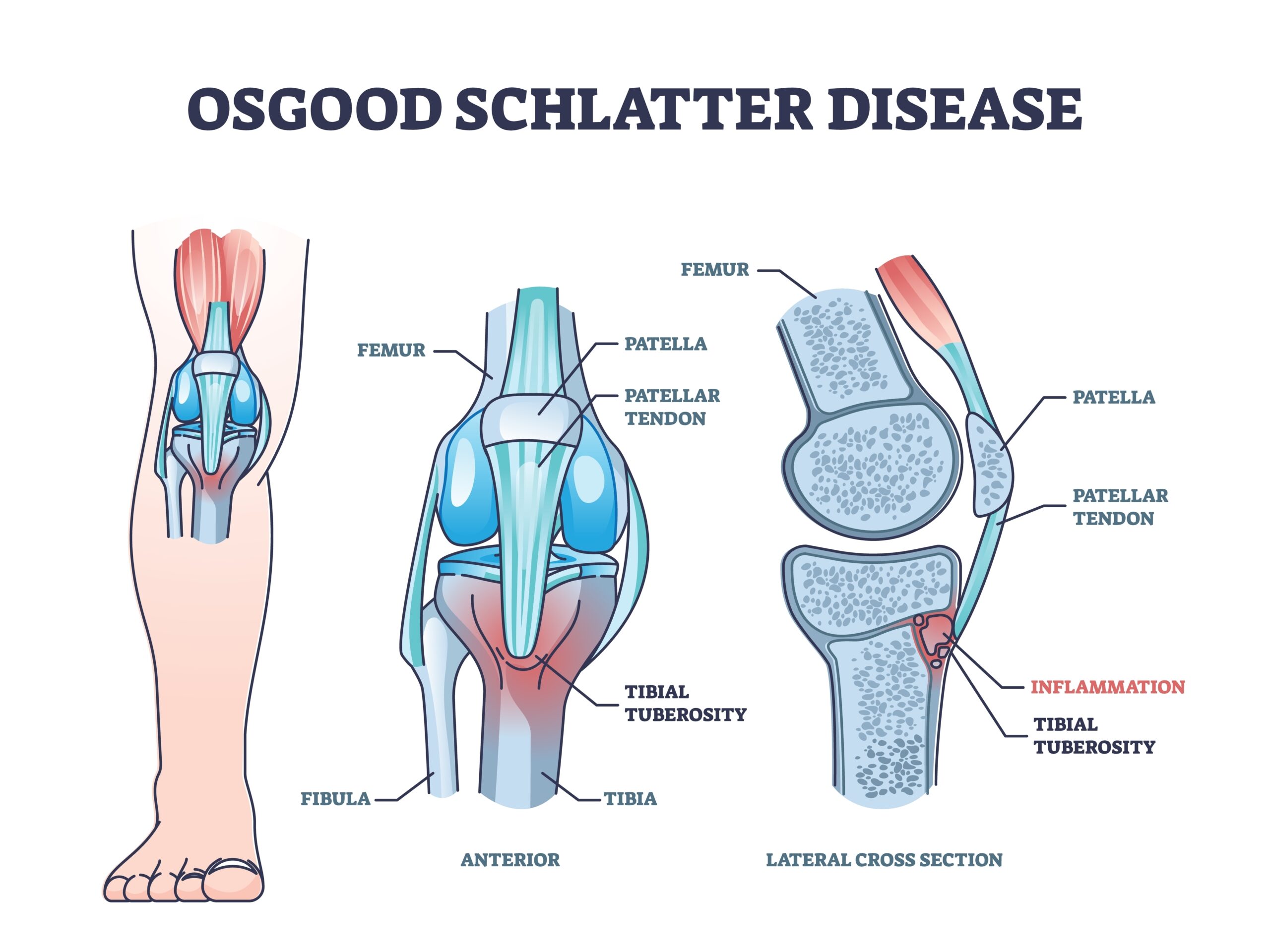 osgood schlatter