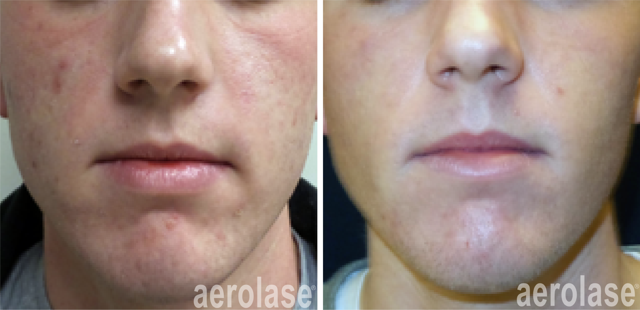 Side-by-side before and after images showing reduced acne and smoother skin on a man's lower face.