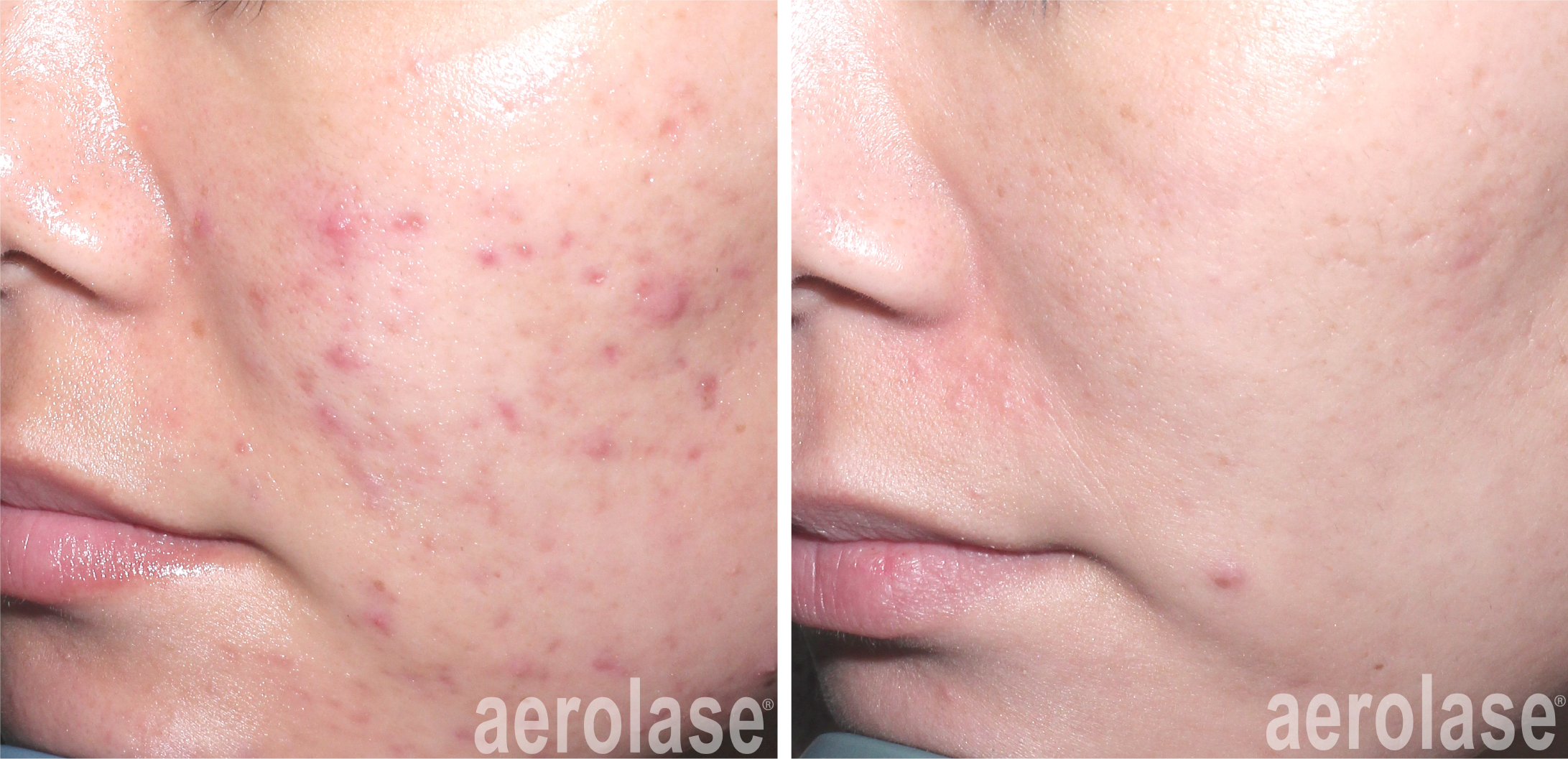 Side-by-side close-ups of a cheek before and after acne treatment showing reduced redness and blemishes.