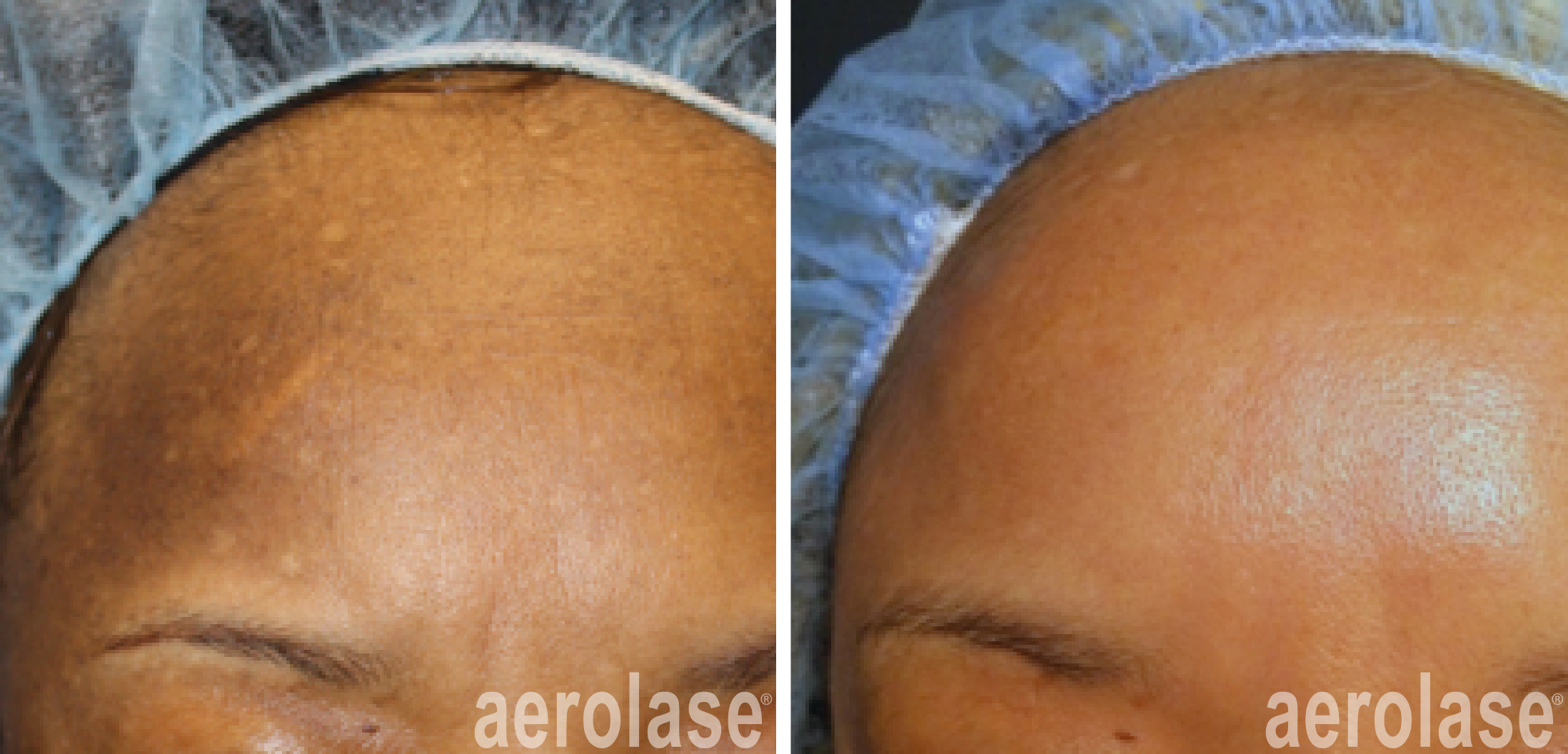 Side-by-side close-up of forehead before and after skin treatment showing reduced dark spots and smoother skin.
