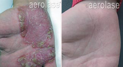 Side-by-side image showing a hand with severe psoriasis and the same hand clear after treatment.