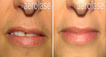 Split image showing upper lip before and after hair removal treatment with smoother skin after.