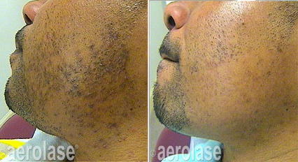 Side-by-side photos of a man's cheek before and after treatment showing reduced dark spots and smoother skin.