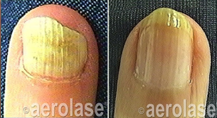 Close-up of a fingernail before and after treatment showing clearer nail on the right.
