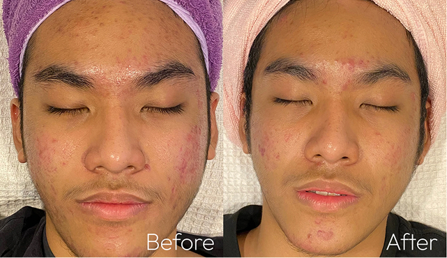 Side-by-side photos of a young man’s face before and after acne treatment with visible skin improvement.