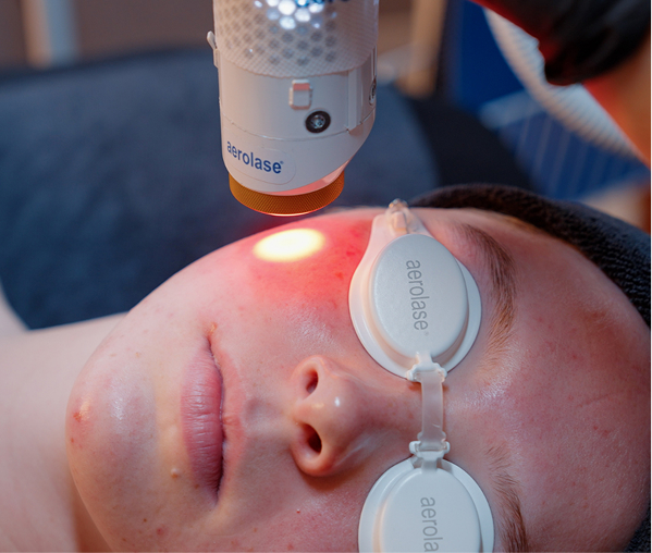Person receiving red light facial treatment using an Aerolase laser device with protective eyewear.