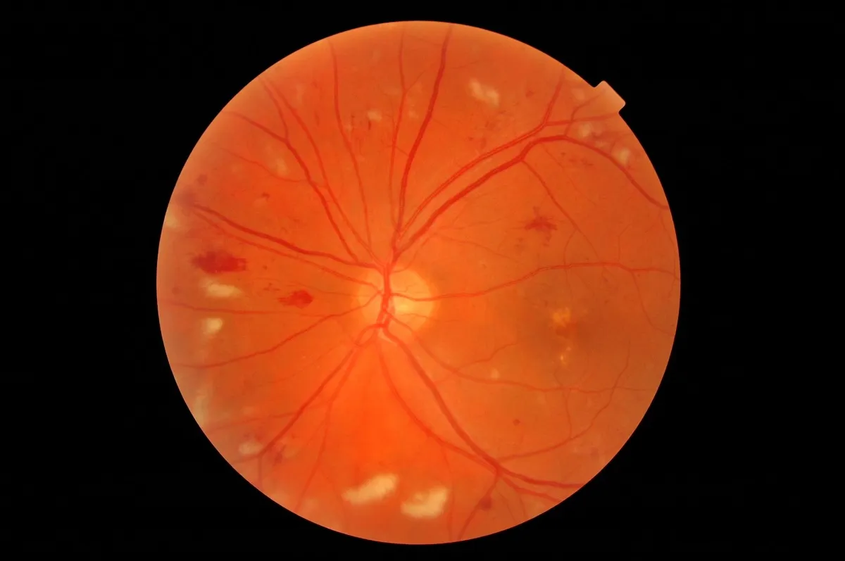 Close-up of an eye retina showing blood vessels, optic disc, and some white and red spots on it.