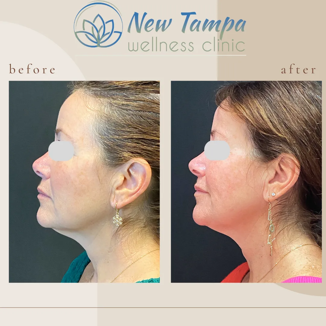 Side-by-side before and after photos of a woman showing facial profile improvement, associated with New Tampa Wellness Clinic.
