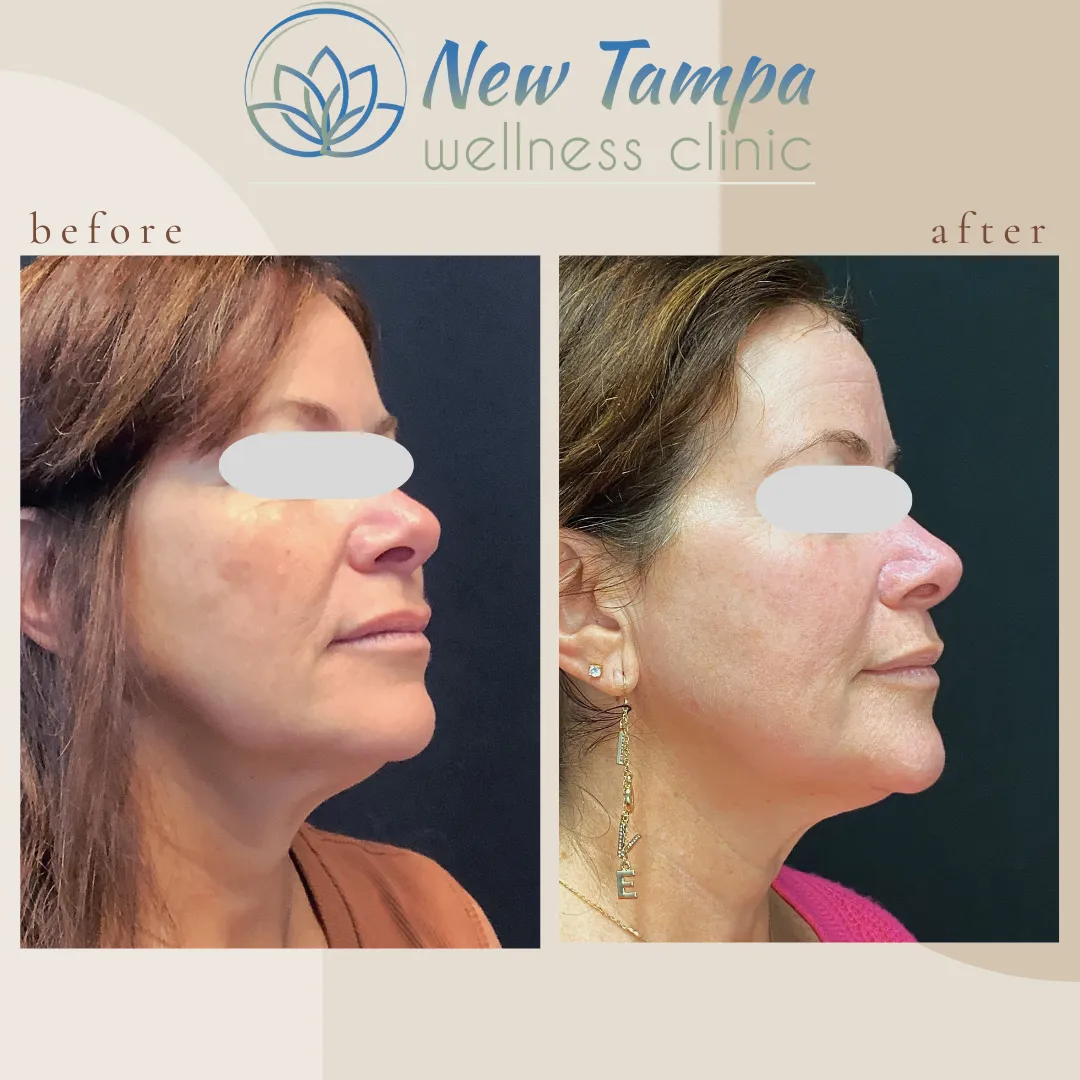 Side-by-side before and after photos of a woman's face showing improved skin texture and contour from a wellness clinic treatment.