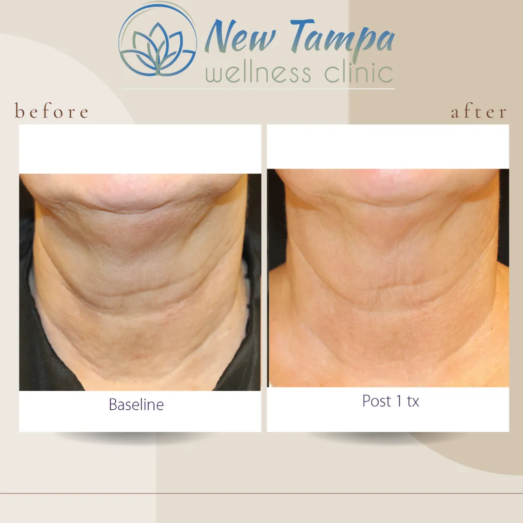 Before and after photos of a neck showing reduced wrinkles and smoother skin after one treatment at New Tampa wellness clinic.